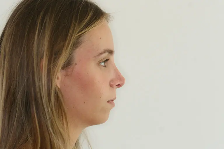 rhinoplastie-a-aixenprovence-lexpertise-du-dr-layoun-rhinoplastie-apres Aix en Provence