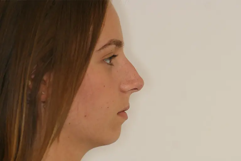 rhinoplastie-a-aixenprovence-lexpertise-du-dr-layoun-rhinoplastie-avant Aix en Provence