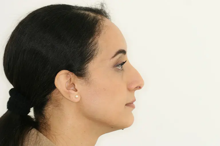 rhinoplastie-a-aixenprovence-lexpertise-du-dr-layoun-rhinoplastie-resultat-avant